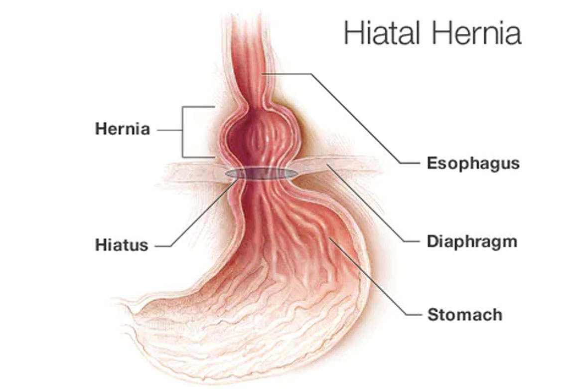 hiatus-hernia-diagram